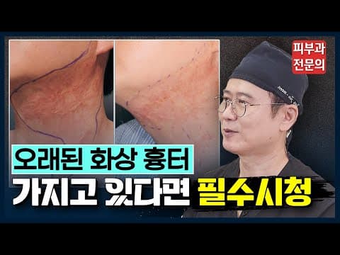 Is it possible to remove old burn scars with laser treatment? | How to remove burn scars, actual ...