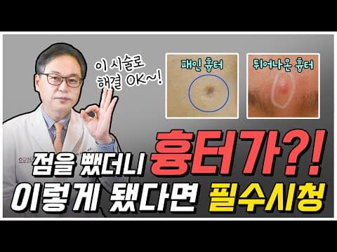 Mole Removal Scar Aftercare And Treatment You Must Watch Before Worrying