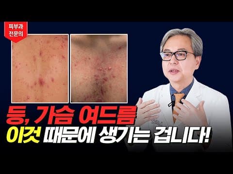 背中ニキビ、胸ニキビがある人は見てください！ニキビの原因と治療法！