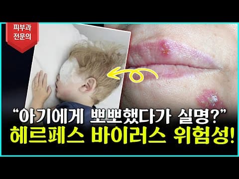 Herpes Virus From Kissing a Baby Can Cause Blindness, Beware