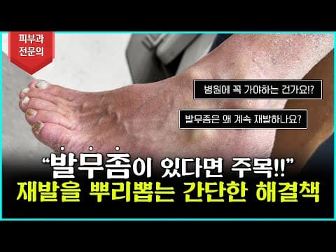 Foot Athlete's Foot: Never Leave It Like This, Sufferers Gather