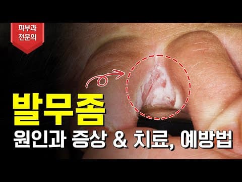 Athlete's Foot Finally Solved: Foot Fungus Treatment Method Explained